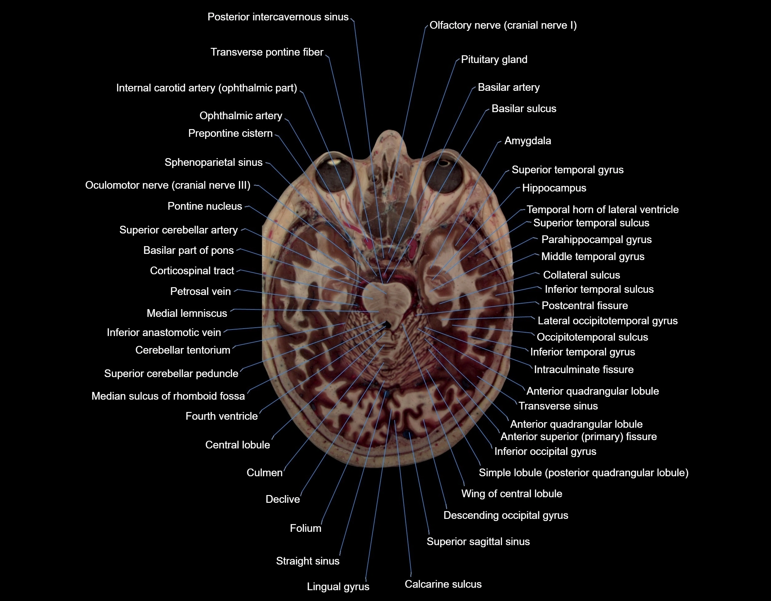MRI Brain axial cross sectional radiology anatomy 3T image  -img-000030.webp
